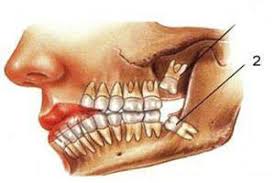 دلایل کشیدن دندان عقل